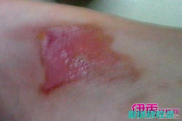 轻微烫伤后的紧急护理措施详解 (轻微烫伤后的处置方法)